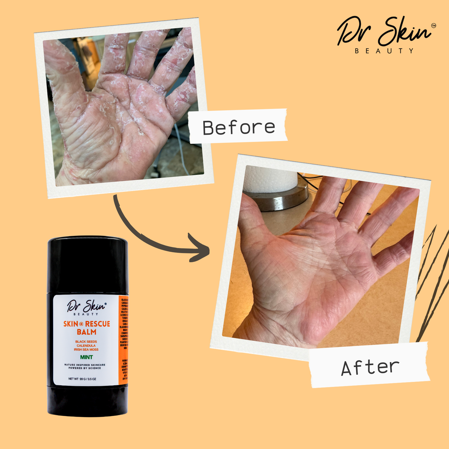 SKIN RESCUE BALM (MINT) 3.5oz | Moisturizing Support for Dry Skin, Eczema, Psoriasis, Cracked Heels, Rashes, and Acne